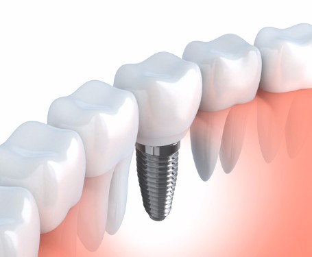 Dental Implant Surgery, Delta Dentist